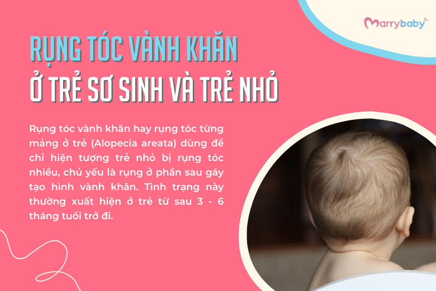 Rụng tóc vành khăn ở trẻ sơ sinh và trẻ nhỏ